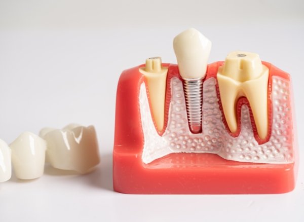 Root Canal Treatment